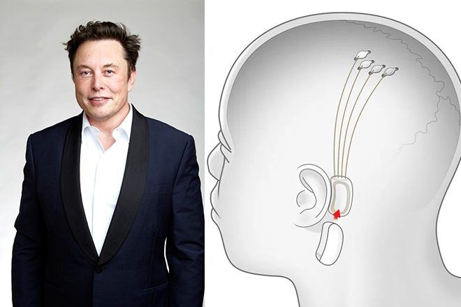 ELON MUSK IS DEVELOPING A BRAIN CHIP TO STREAM MUSIC INSIDE YOUR HEAD